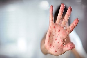 شناسایی ۶۷۴ ابتلا به سرخک در سال گذشته/ هشدار؛ تبلیغات علیه واکسیناسیون در شبکههای اجتماعی